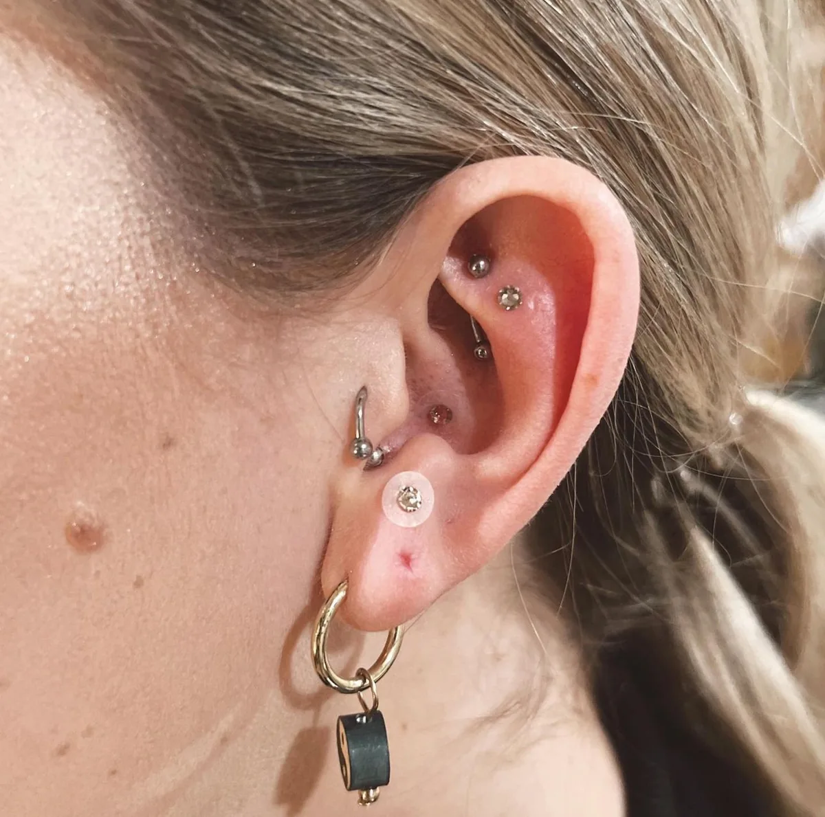 Auricular acupuncture: fine needles and ear seeds on the outer ear, the protocol many VA clinics use for pain and stress