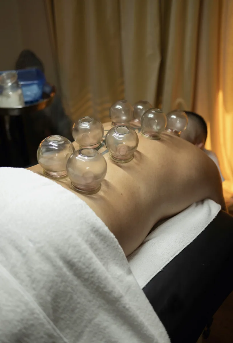 Glass cups seated along a draped patient's back in the treatment room