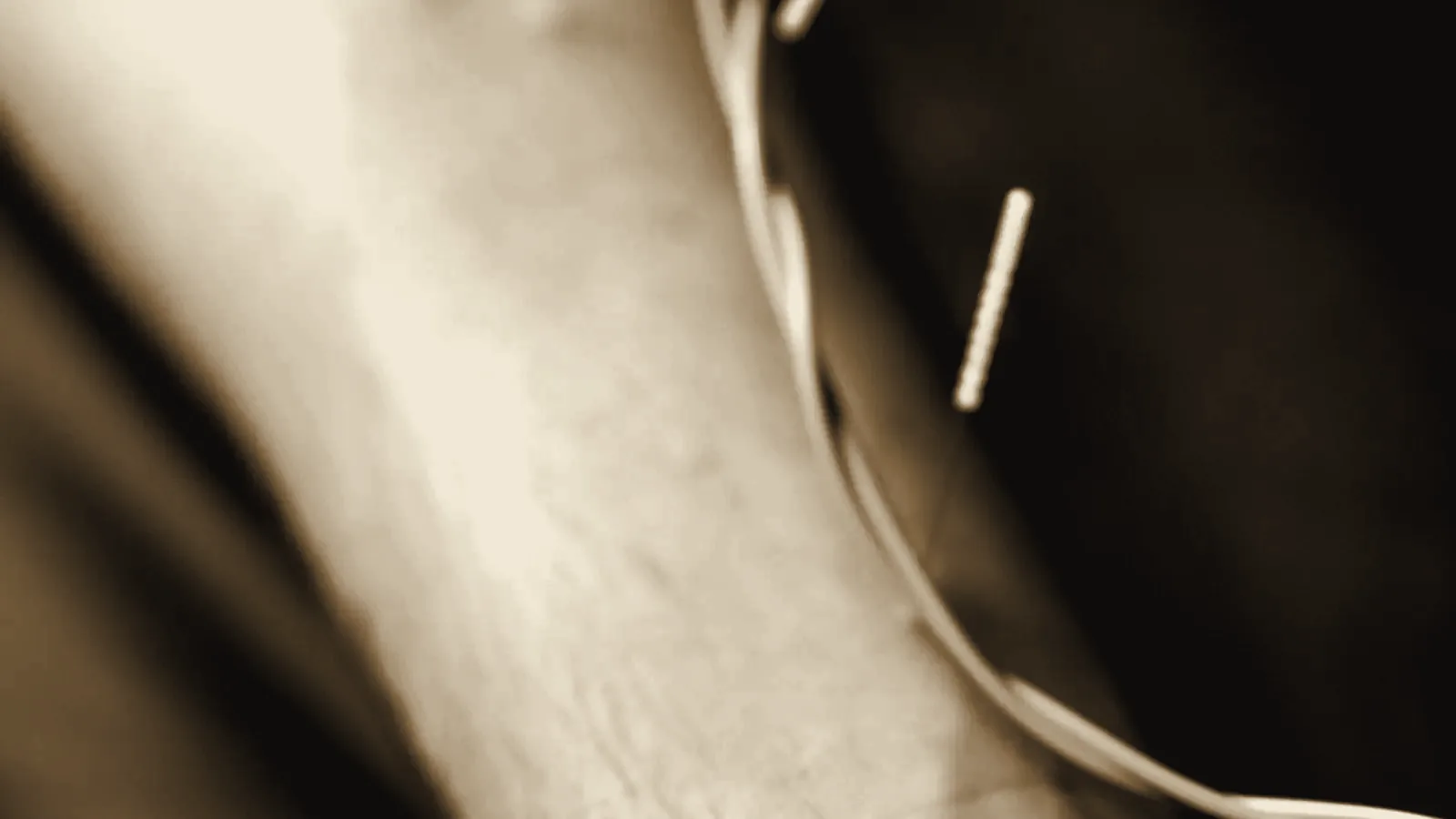 Electroacupuncture: lead wires clipped to needles on a patient's forearm
