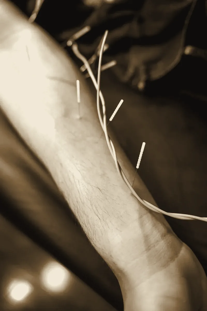 Electroacupuncture leads clipped to needles along a patient's forearm