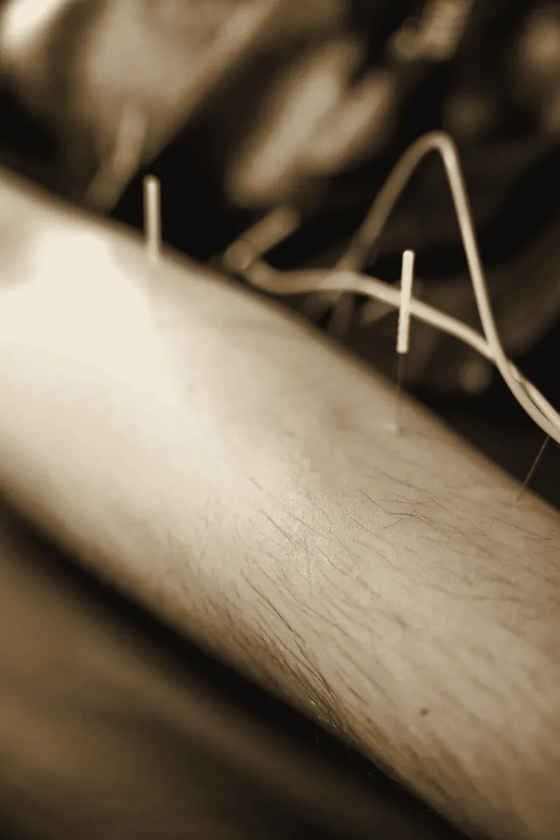 A second view of the leads and needles on the forearm during electroacupuncture