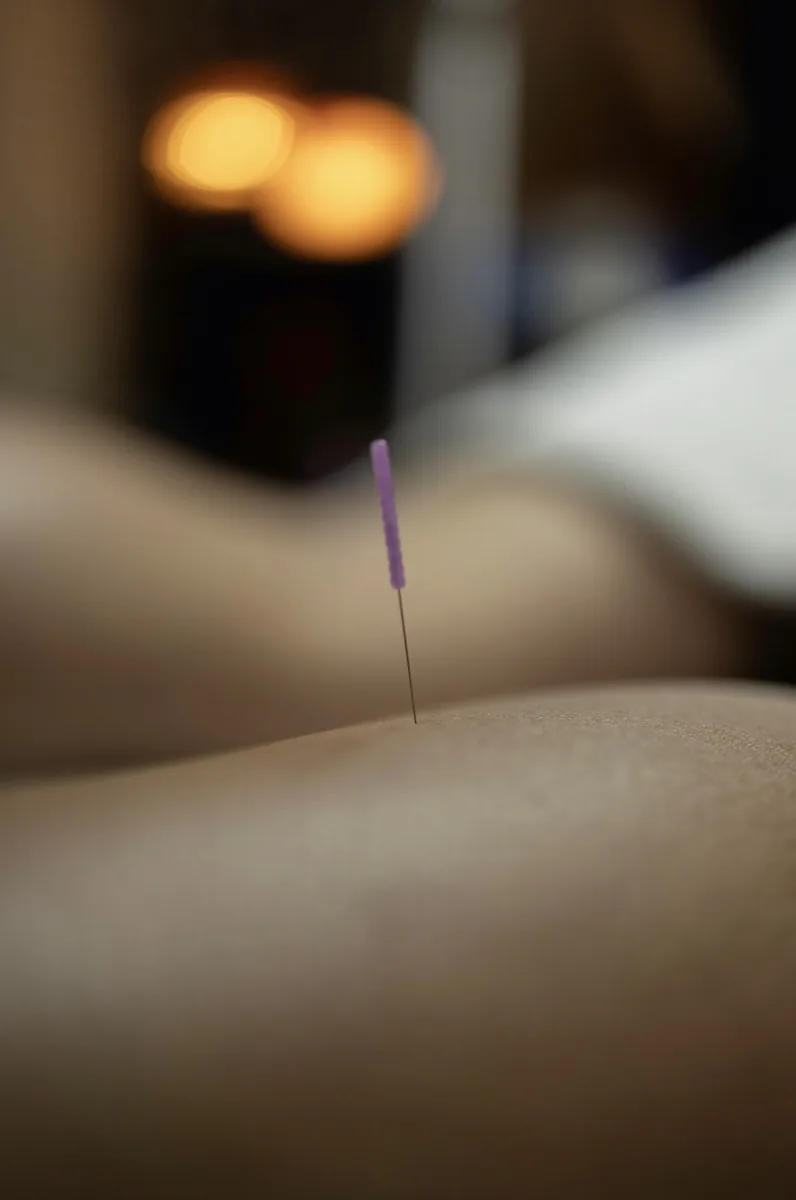 Close-up of a single acupuncture needle resting in the skin