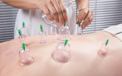 Cupping Therapy Explained: What It Is and How It Can Help You