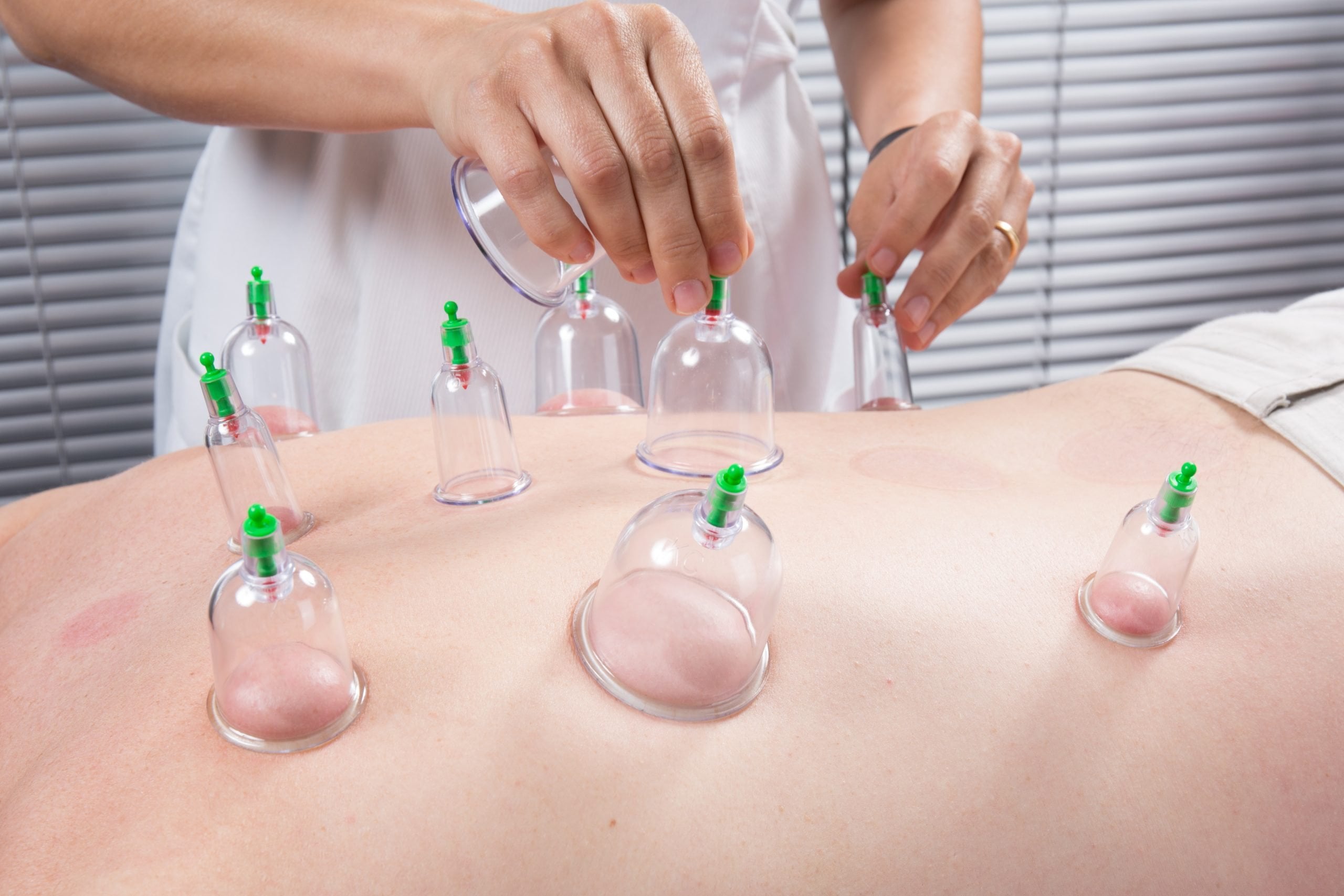 Cupping Therapy Explained: What It Is and How It Can Help You