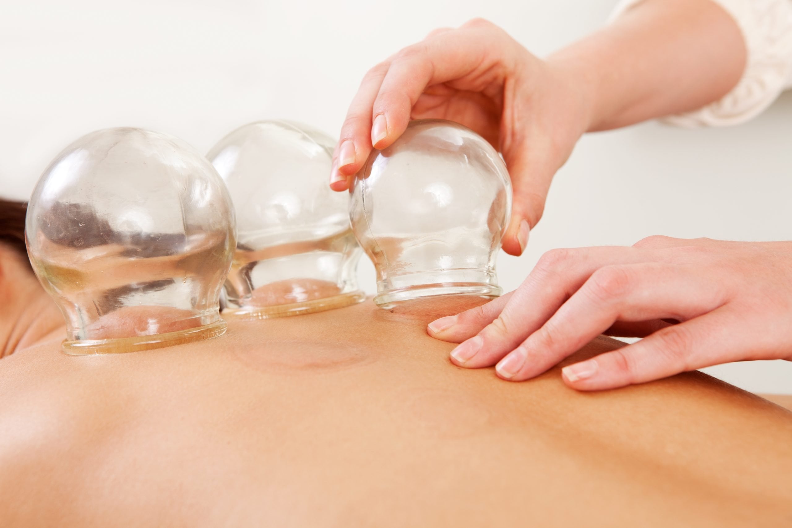 Diving into the Depths of Cupping Therapy: An Acupuncturist’s Guide to Wet, Dry, and Fire Cupping