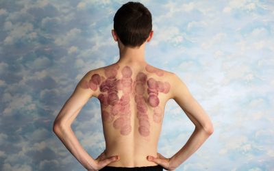 Enhancing Sports Performance: The Remarkable Benefits of Cupping Therapy