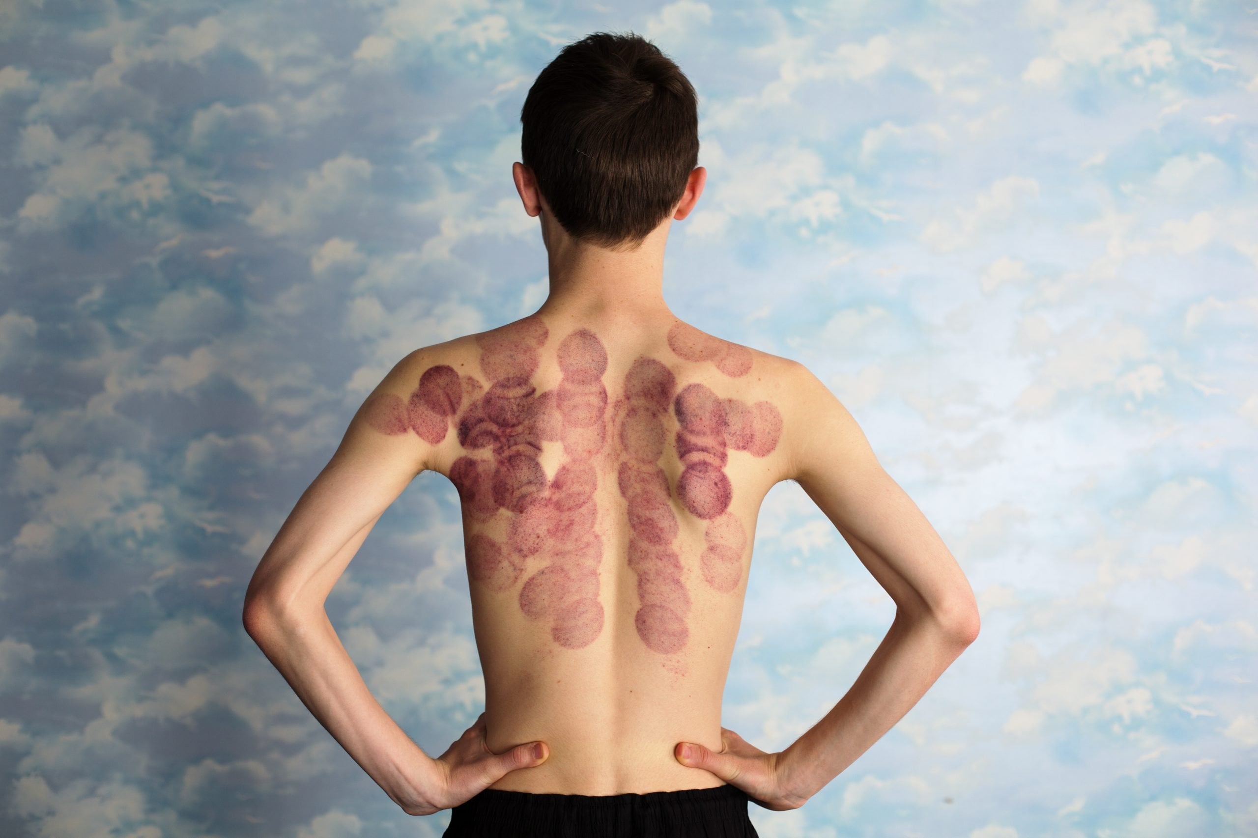 Enhancing Sports Performance: The Remarkable Benefits of Cupping Therapy