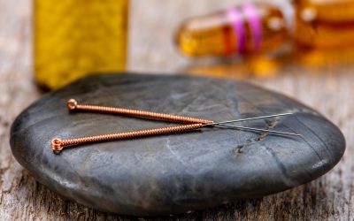 Relieving Pain with Acupuncture at AcuMedGroup