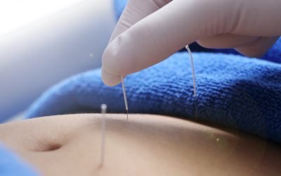 Acupuncture for Chronic Pain: How It Works and What to Expect