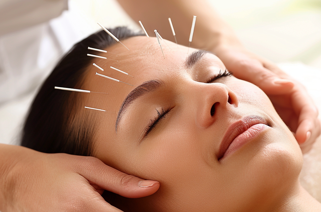 Acupuncture for Stress Relief: A Natural Solution