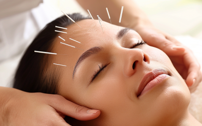 Acupuncture for Stress Relief: A Natural Solution
