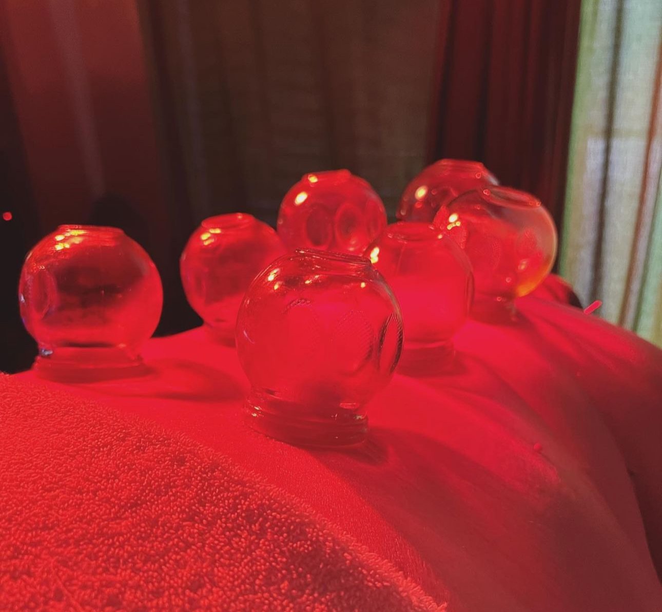 The Art of Cupping Therapy: Complementing Acupuncture for Holistic Healing