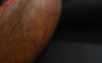 Acupuncture vs Dry Needling: What’s the Difference and Why It Matters