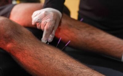 Acupuncture for Sciatica in Kissimmee, FL: A Drug-Free Path to Relief