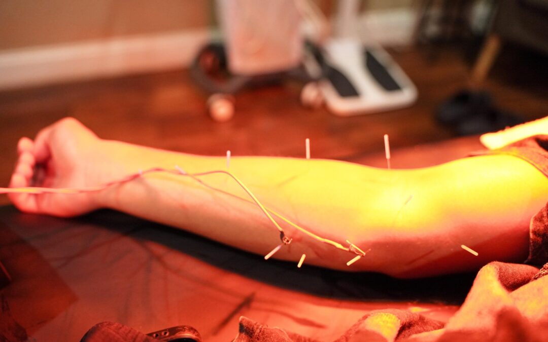 What VA-Covered Acupuncture and Pain Treatments at AcuMedGroup Mean for Veterans